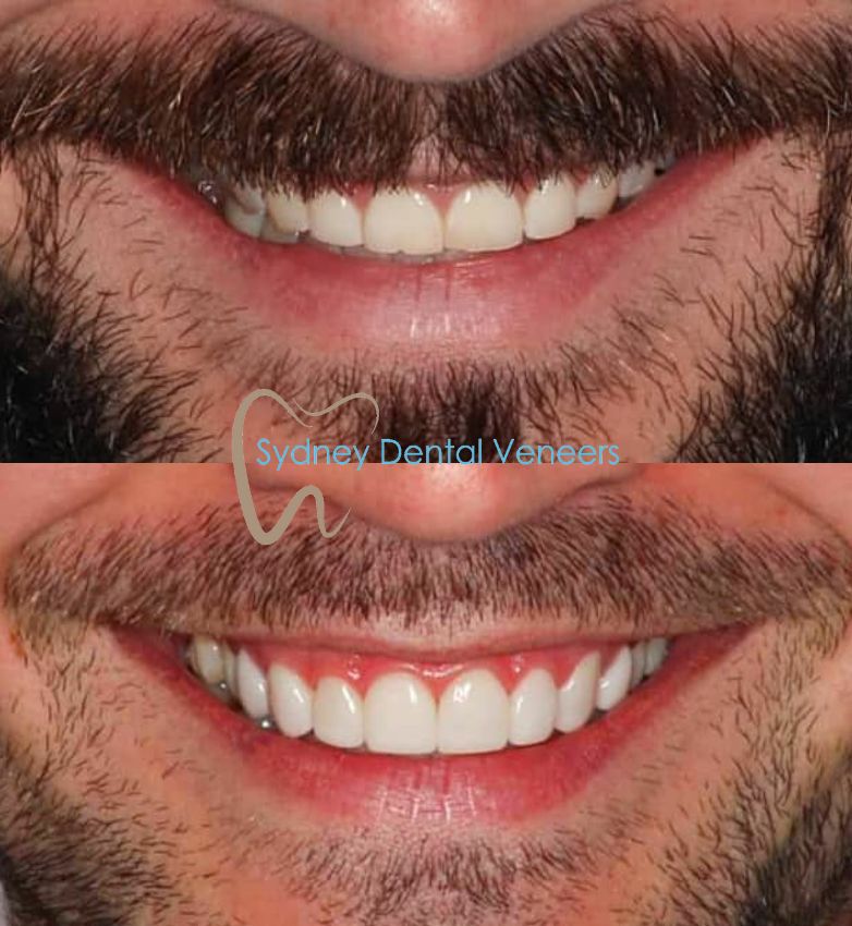 Porcelain Veneers Sydney