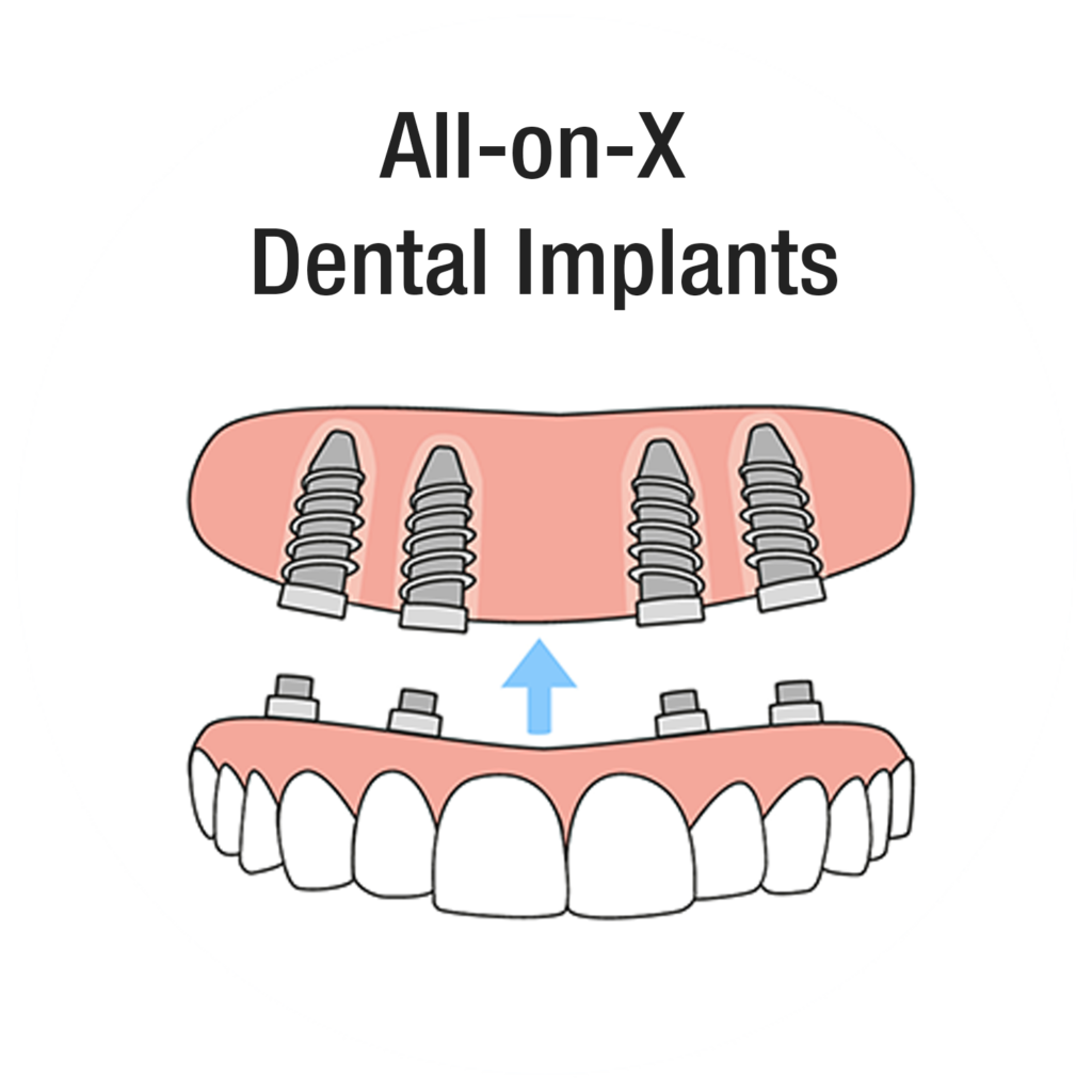 All-on-X Dental Implants