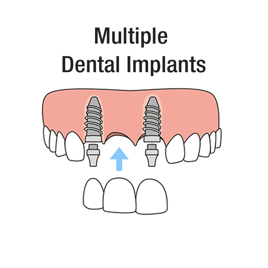 Multiple Dental Implants