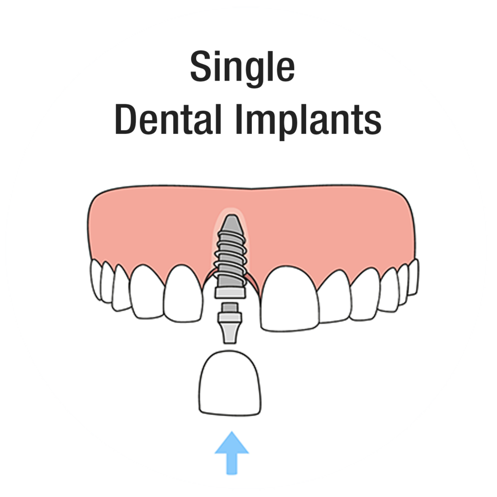 Single Dental Implant
