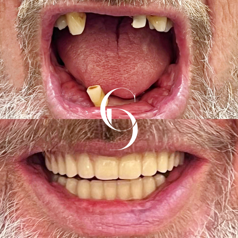 All-On-4 Dental Implants