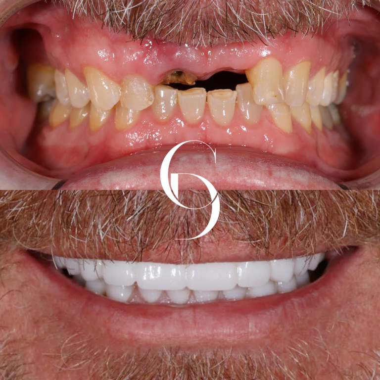 All-On-4 Dental Implants