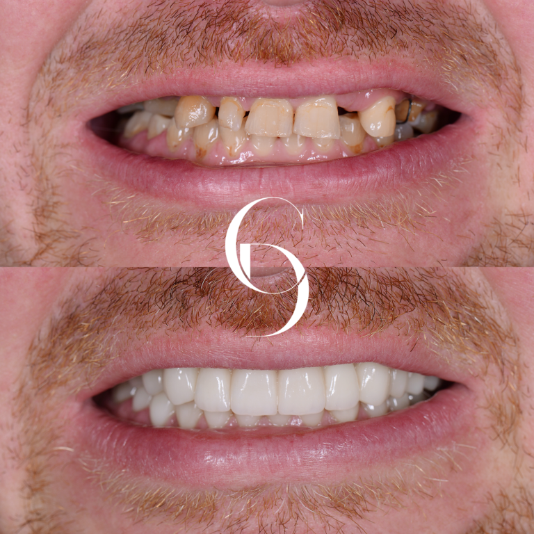 All-On-X Dental Implants