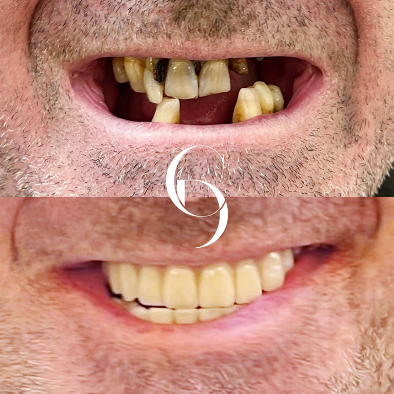 All-On-X Dental Implants