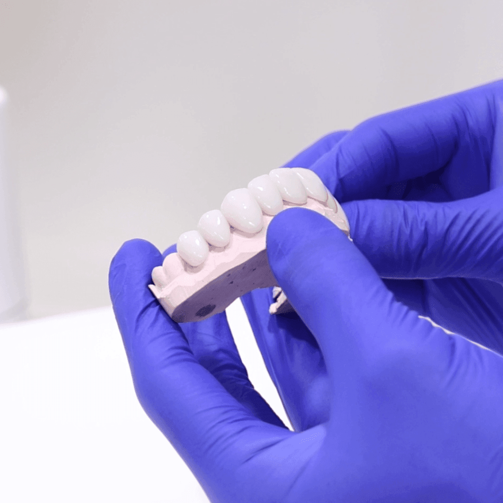 Porcelain veneers model at Sydney Dental Veneers