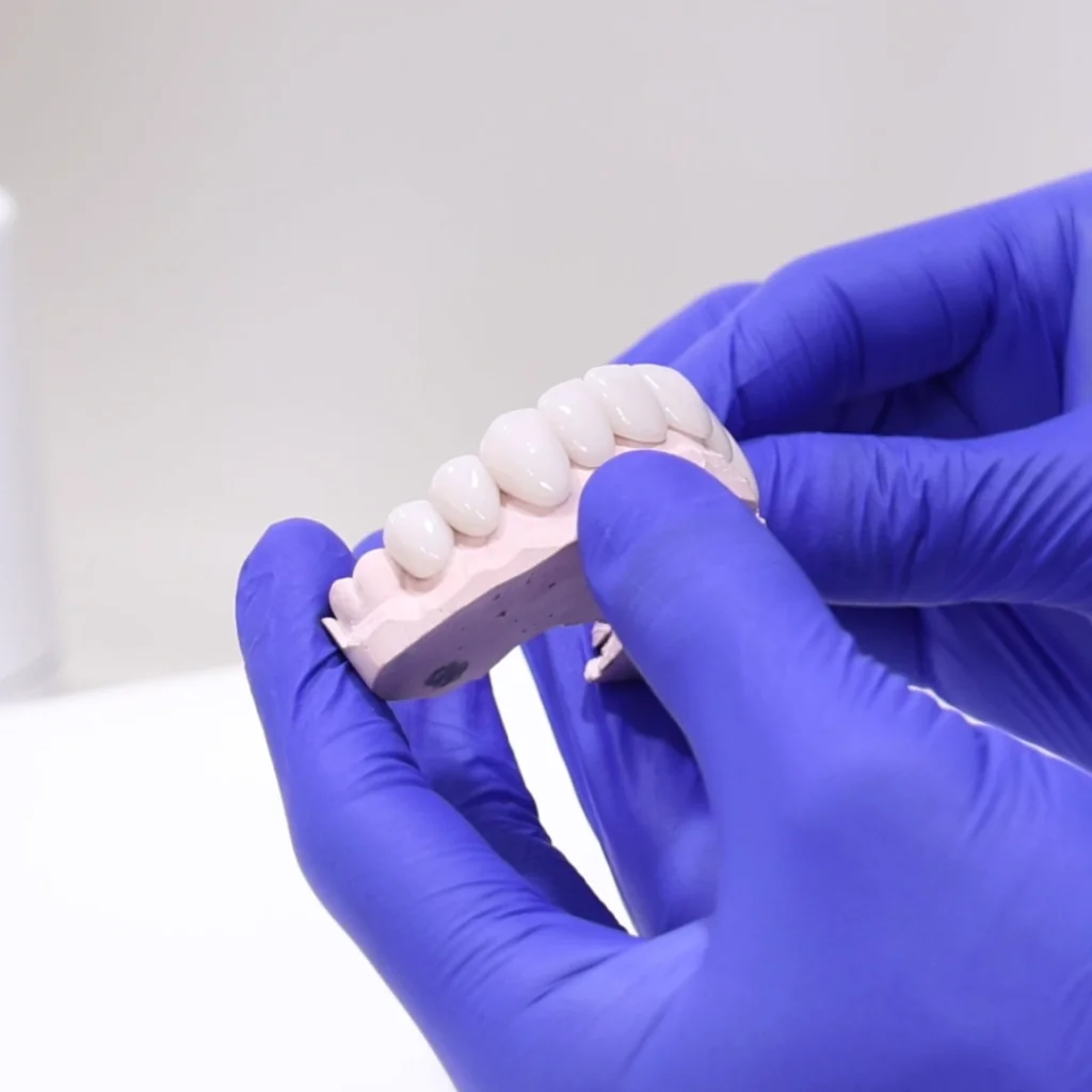Porcelain veneers model at Sydney Dental Veneers