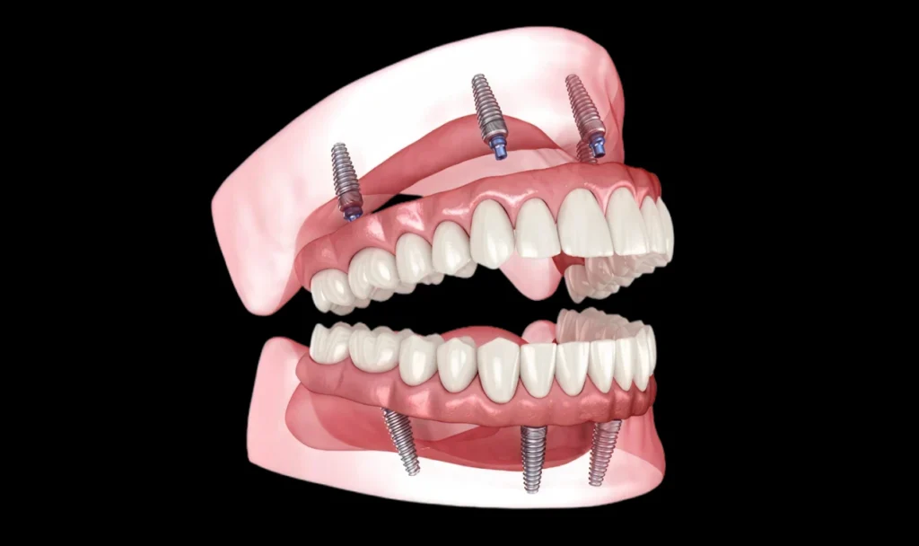 Model of a full arch implant-supported restoration