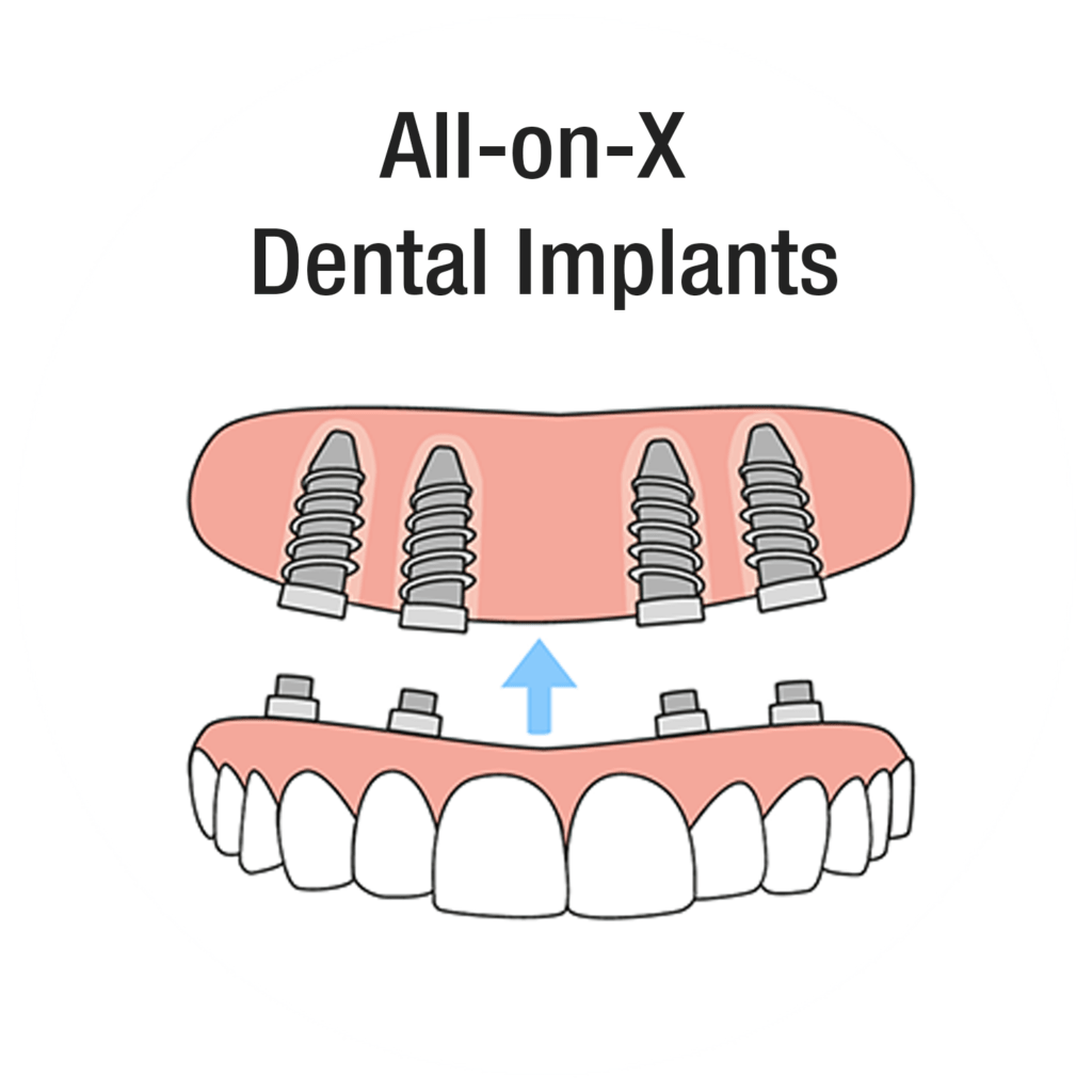Diagram showing All-on-X implant-supported full arch treatment
