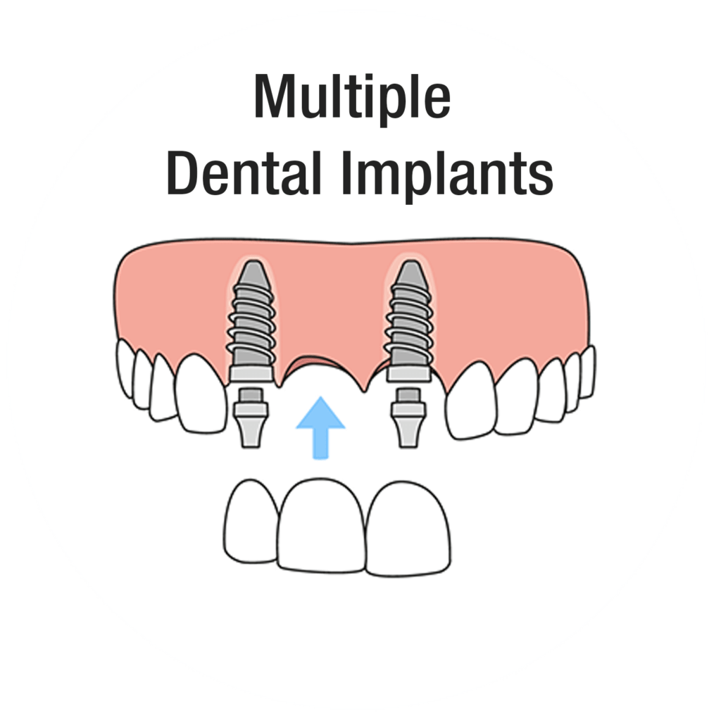 Diagram showing multiple dental implants replacing several missing teeth