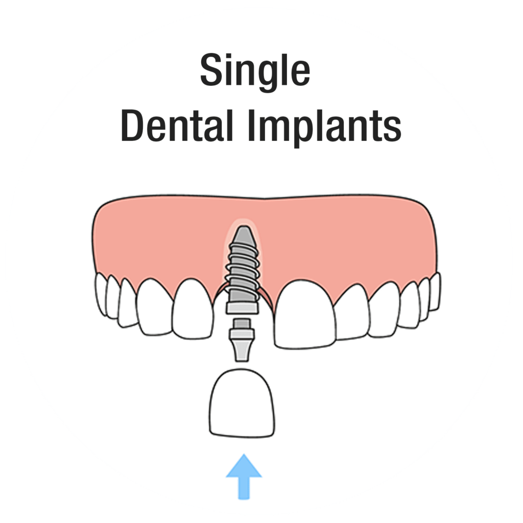 Diagram showing a single dental implant replacing one missing tooth