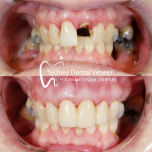 Dental Implants